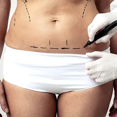 Img-Dr_Juan_Santamaria_Procedimiento-Abdominoplastia-LCP