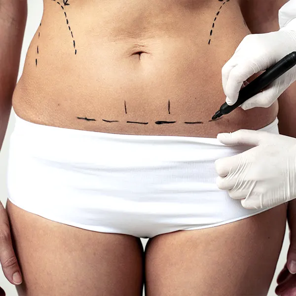 Img-cirujano-plastico-medellin_Procedimiento-Abdominoplastia